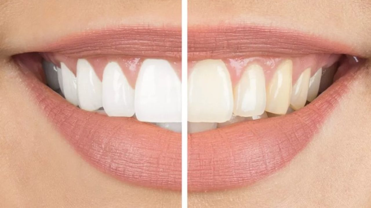 Diş Neden Sararır / Diş Beyazlatma Teknikleri